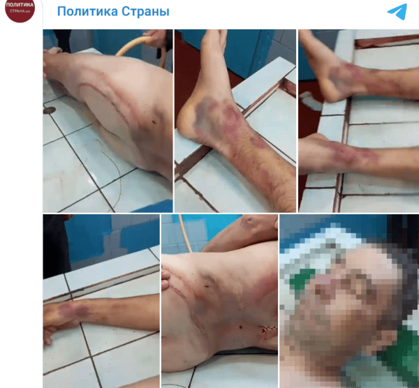 동원됐다가 사망한 우크라이나 남성의 몸. 온 몸에 멍이 든 게 보인다/캡처